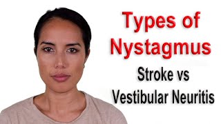 Types of Nystagmus Due to Stroke vs Vestibular Neuritis Causing Persistent Dizziness or Vertigo [upl. by Artied]