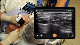 Interscalene Brachial Plexus Block  Ultrasoundguided  Upper Trunk Block  ISB  Anatomy Review [upl. by Trebo]