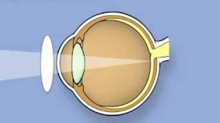 Retinoscopy of the eye Ophthalmology [upl. by Rozina]