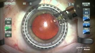 Corneal Relaxing Incisions  NAPA NOMOGRAM [upl. by Yvan673]