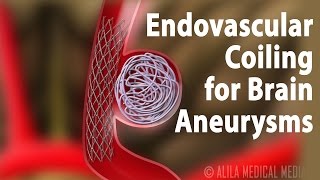 Endovascular Coiling for Brain Aneurysm Animation [upl. by Astiram397]