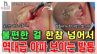 🔨파고드는 발톱  유해균 발톱🔨 역대급 통증에 시달리는 고객님의 발😭 이렇게 파고들 줄이야 발톱닥터 내성발톱 내성발톱교정 내성발톱관리 지축역 무좀발톱관리 [upl. by Tharp423]