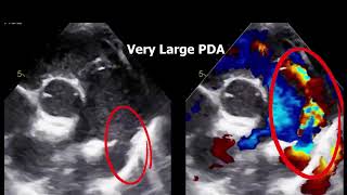 Abdominal Aortic Doppler Flow Patterns in echocardiography [upl. by Gnot]