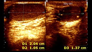 Cryptorchidism in children  Testicular Microlithiasis  Undescended testis [upl. by Maggee]