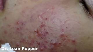 Acne Blackheads Whiteheads removals on face part 8 [upl. by Kepner459]