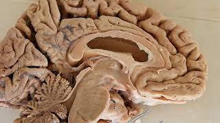 Third Ventricle  neuroanatomy  boundaries  recesses [upl. by Cherey]