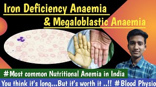 Iron Deficiency Anaemiaamp Megaloblastic AnemiaBlood PhysiologyLecturesMBBS hindi Ashish [upl. by Kele]