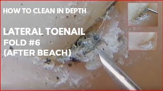 How to clean in depth lateral toenail fold 6 After beach [upl. by Niuqaoj]