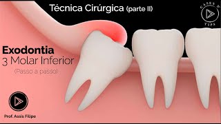 Exodontia terceiro molar inferior passo a passo clinico [upl. by Eahsan424]