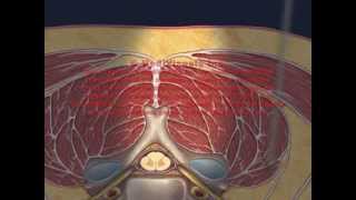 Cervical Interlaminar Epidural Injection Animation [upl. by Elyrrad]