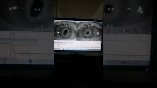 Discoria videonistagmografía seguimiento ocular lento [upl. by Neelhtakyram372]