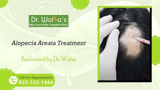 Alopecia Areata Treatment I How To Stop Alopecia Areata From Spreading [upl. by Hamford]