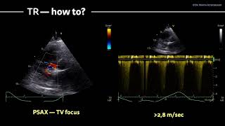 〖Echocardiography〗 Diastolic dysfunction VIII  how to measure 🫀 [upl. by Gnemgnok656]