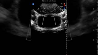 Bladder Ureteric Jets Butterfly iQ Clinical Image [upl. by Nostets413]