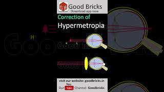 Defects of Eye  correction of hypermetropia  CBSE  TelanganaClass 10  Physics cbseclass10bio [upl. by Gowrie]