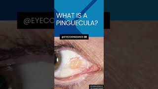 what is a pinguecula ¦eyecognizance [upl. by Beitz422]