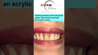 FRONT Teeth Smile Makeover with Zirconia Crown Dr Srishti Bhatia smilemakeover smile zirconia [upl. by Moule]