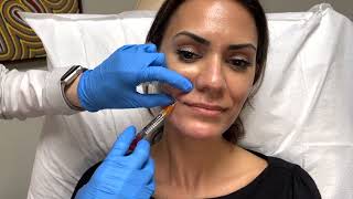 RHA Filler Informational Video [upl. by Leisha]