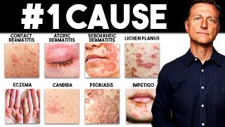 The MOST Common Deficiency in All Skin Diseases Dermatitis [upl. by Jelsma410]