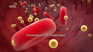 Arteriosclerosis [upl. by Netfa667]