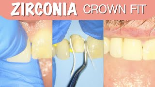 HOW TO CEMENT A ZIRCONIA CROWN  4K Resolution [upl. by Panther]