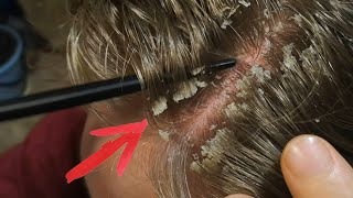 lift up scalp flakes w intense psoriasis scratching you need after this vote🇺🇸 [upl. by Kreager]