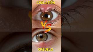 Chalazión vs Orzuelo orzuelo chalazion Tratamiento oftalmologia infeccionOcular [upl. by Leigh256]