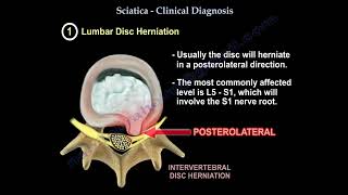 Sciatica symptoms  diagnosis and treatment conditions that mimic sciatica [upl. by Dalia]