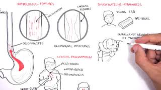 GORD GERD Gastro Oesophageal Reflux Disease  Overview pathophysiology treatment [upl. by Leuqim]