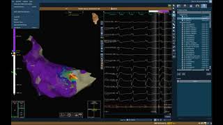 Ischemic VT storm Ablation EP study [upl. by Kelam]