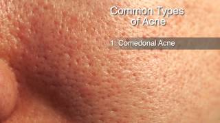 How to Treat Different Types of Acne [upl. by Golding]