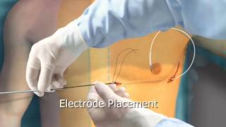 Subcutaneous ICD Animation  Arrhythmiaorg [upl. by Ennaisoj265]