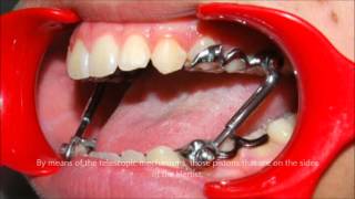 Presenting the Herbst appliance An Introduction  Tom Nasiopoulos Orthodontist [upl. by Lledualc]