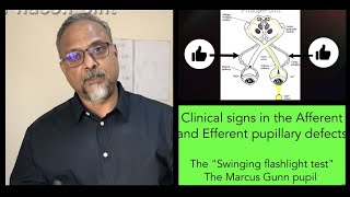 Clinical Signs in Afferent and Efferent pupillary defects  The Marcus Gun Swinging Flashlight test [upl. by Margy119]