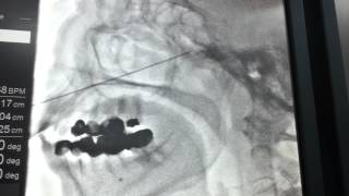 Nevralgie trijumeau Electrocoagulation [upl. by Noemad]