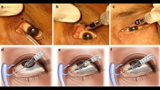 Probing and Dilators of surgical instruments [upl. by Rechaba886]