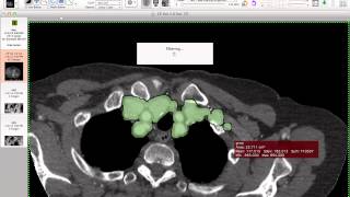 Aortic Segmentation  How i do it with Osirix [upl. by Ragan]