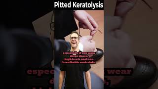 How To Get Rid of Pitted Keratolysis ONCE amp FOR ALL [upl. by Ellednahs]