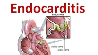 Endocarditis [upl. by Kai375]