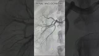 Why might I need a renal angiography [upl. by Asirahc]