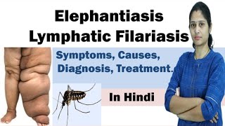 Elephantiasis  Filariasis  Symptoms Causes Diagnosis Treatment Prevention  In Hindi [upl. by Annaoi566]