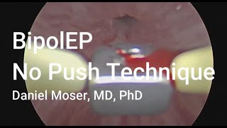 130g BipolEP  No Push Technique [upl. by Shellans]