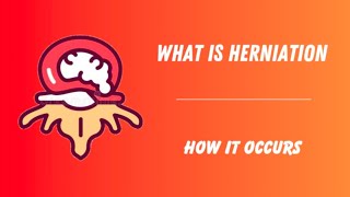 What is Herniation  How it occurs  Dream Max [upl. by Cimah]