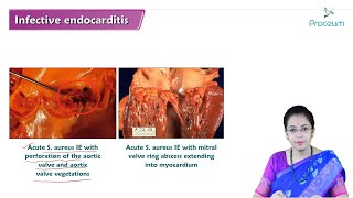 Infective Endocarditis Hindi  Internal Medicine [upl. by Haerr]