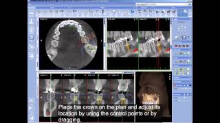 Using abutments and crowns in Planmeca Romexis® [upl. by Even]