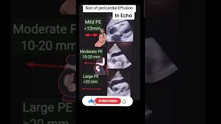 Size Pericardial effusion echo ultrasound babyviralvideo trending baby [upl. by Elbas640]