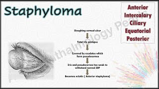 Staphyloma  Undergraduate Examination revision pearls 15 [upl. by Niddala]