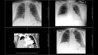 Chest tube probably injured phrenic nerve and cause right diaphramatic paralysi [upl. by Nishom]