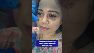 UnderEye Filler Treatment  Skin Clinic  Skin Treatment  Kolkata  youtubereels youtubeshorts [upl. by Zimmermann]