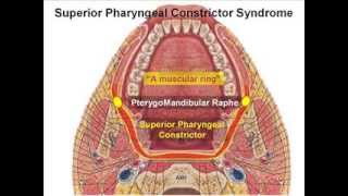 SuperiorPharyngealConstrictorSyndromeflv [upl. by Lak]